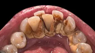 Crowding Teeth Will Increase Tartar Buildup | Scaling