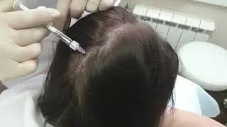 Лечение волос филлер-биоревитализанта Hair Filler.