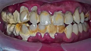 25-Minute Scaling Process Video | Tartar | Dentist | Dokter Gigi Tri Putra