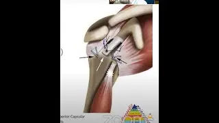 Superior Capsular Reconstruction with Long Head of Biceps