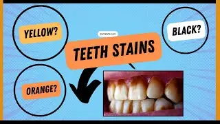 Why Teeth Stain and How To Prevent Staining