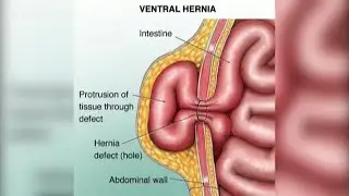 Abdominal wall hernias