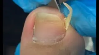 Super long toenail cutting