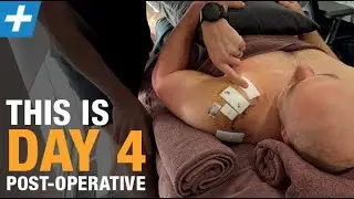 Rotator Cuff Surgery (Supraspinatus) - Day 4 Post-operative