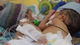 Swiss doctors separate ′youngest ever′ conjoined twins