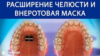 Типы ортодонтия — Расширение челюсти и внеротовая маска ©