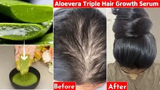 This👆🏼Aloevera Trick-Turned My Bald Hair to Thick Heavy Hair- 30 Days-Hair Loss to Thick Dense Hair