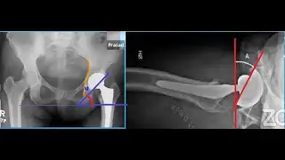 Acetabular Component Position in Total Hip Replacement