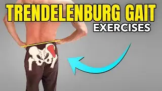 3 Exercises to Correct a Trendelenburg Gait Pattern