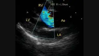 Colour Doppler Echo in Tetralogy of Fallot