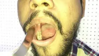 Mouth Examination - Examination of Oral Cavity and Oropharynx- Dr Mohan Bansal (Like & Subsribe)