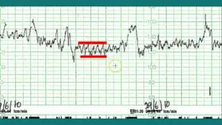 Ctg interpretation - Normal CTG