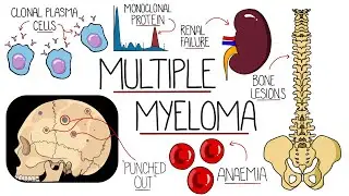 Understanding Multiple Myeloma (Multiple Myeloma Explained Clearly)