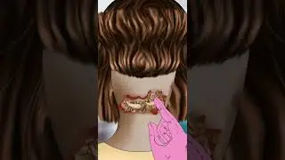 #asmr SMR Giant hardened flakes dandruff removal at hairline Scalp treatment #animation #beauty