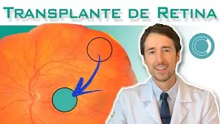 Transplante de Retina