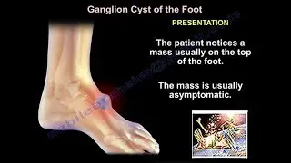 Foot and  Ankle ganglion cyst   - Everything You Need To Know - Dr. Nabil Ebraheim