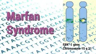 Marfan Syndrome | Heart, Skeletal & Eye Complications | Connective Tissue Disorder