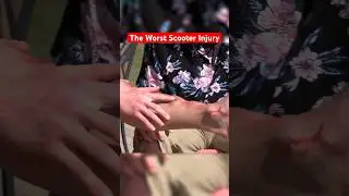 The WORST Scooter Injuries of All Time… #funny #science #comedy