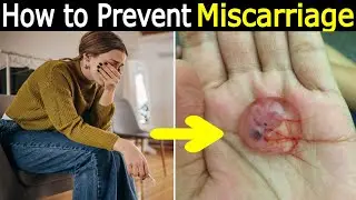 How to Prevent Miscarriage in Early Pregnancy with PCOS | Expert Tips and Advice