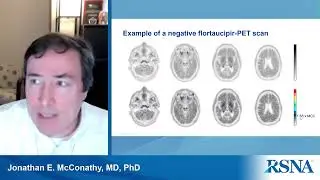 Unlocking the Radiologist’s Role in Alzheimer’s Diagnosis and Treatment