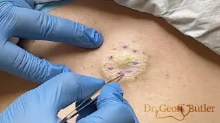 Removal of an epidermal cyst on the back