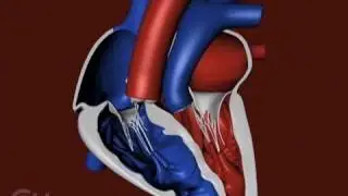 The Structure of a Heart with Transposition of the Great Arteries (TGA) - CHOP