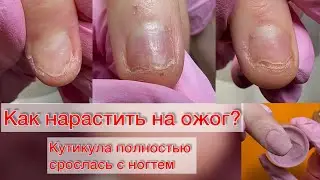 КАК НАРАСТИТЬ НА ОЖОГ? НОГТИ ПОСЛЕ ОЖОГА ЧЕМ МОЖНО ПОКРЫВАТЬ? Дип система. Титановые ногти