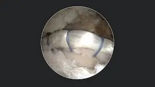 Labral Augmentation Using Knotless 1.8 FiberTak® Anchors, Gen2