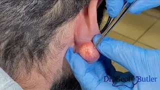 Removal of an epidermal cyst on the earlobe