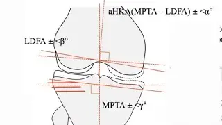 Personalised Alignment in Knee Replacement