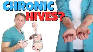 Why Do I Have Chronic Hives (Urticaria)