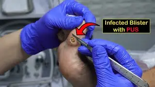 Infected Blister POPS during Treatment