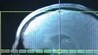 COVID brain fog: What it is and what it means for virus patients