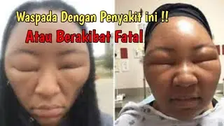 Ginjal Bocor Berbahaya? ini obatnya