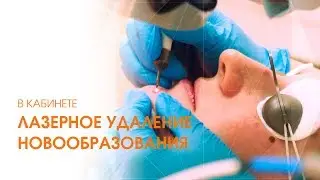 Удаление РОДИНКИ НА ЛИЦЕ лазером / Лазерное удаление НЕВУСА