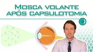 Mosca volante após capsulotomia com YAG laser.