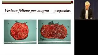 Tulžies pūslės ir tulžies latakų chirurginės ligos