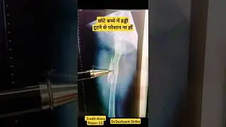 Amazing Fracture Recovery 🔥 बच्चों में हड्डी का तुरंत जुड़ना 