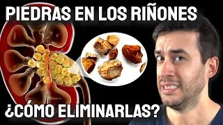 How TO GET RID of KIDNEY STONES| Best TREATMENT