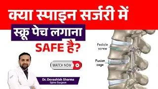 How Safe Are Screws & Rods in Spine Surgery? Spine Surgeon In Delhi, India - Dr Devashish Sharma