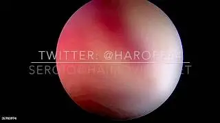 embryo-fetoscopy by Hysteroscopy