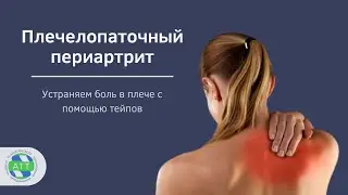 Плечелопаточный периартрит. Тейпирование плеча.