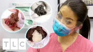 8 Satisfying Minutes Of Popping Cysts, Lipomas And Blackheads! | Dr. Pimple Popper