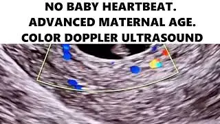 NO BABY HEARTBEAT. ADVANCED MATERNAL AGE. COLOR DOPPLER ULTRASOUND #ultrasound #pregnancytest