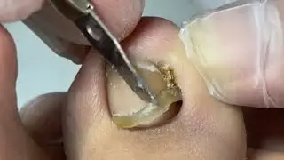 Easy nail reapir