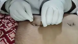 stich Remove For lapro Surgery patient full vlog