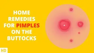 Booty Breakouts No More: Effective Home Remedies for Pimples on Your Butt