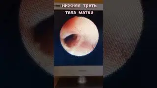 ИЗВЛЕЧЕНИЕ МИРЕНЫ ИЗ ПОЛОСТИ МАТКИ ЧЕРЕЗ 6 ЛЕТ.