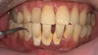 REMOVE TARTAR | SCALING | Dentist | Dokter Gigi Tri Putra