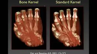 MDCT Protocol Design for MSK Studies